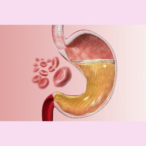 Úlceras gástricas en cerdos: influencia de la alimentación